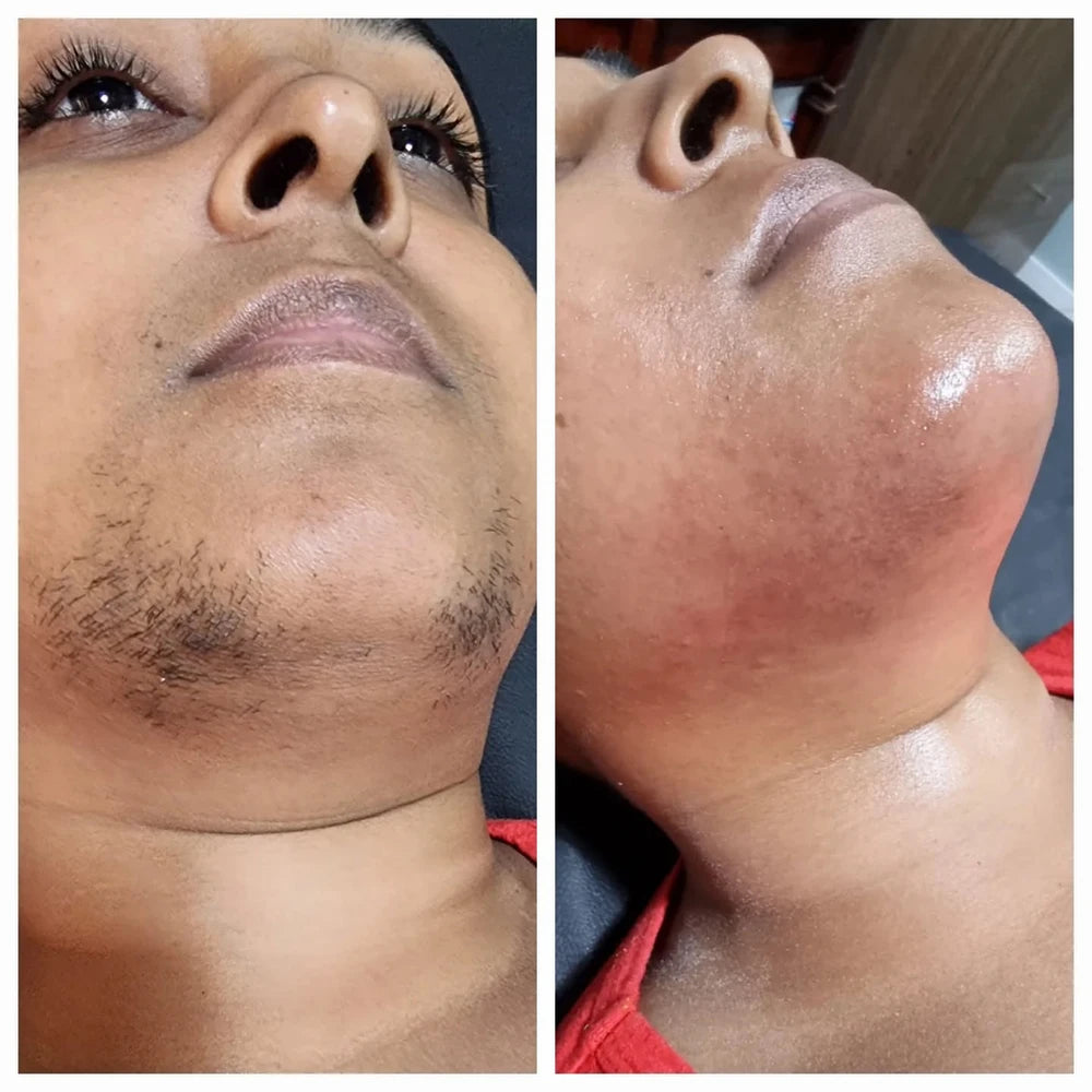 Hair Removal Oil